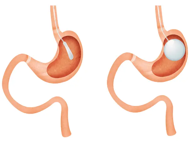 Swallowable-Gastric-Balloon​