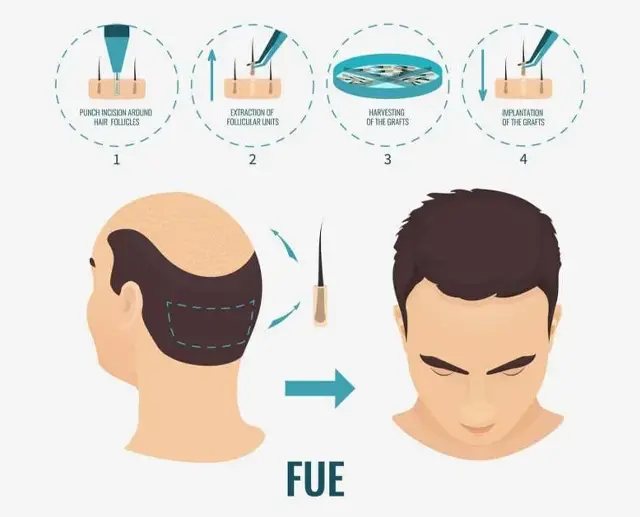 FUE-Haartransplantation FUE-Haartransplantation
