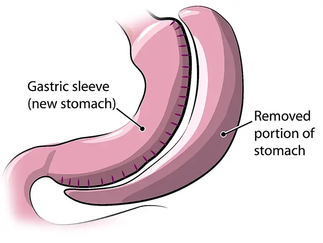 Gastric Sleeve Surgery Gastric Sleeve Surgery