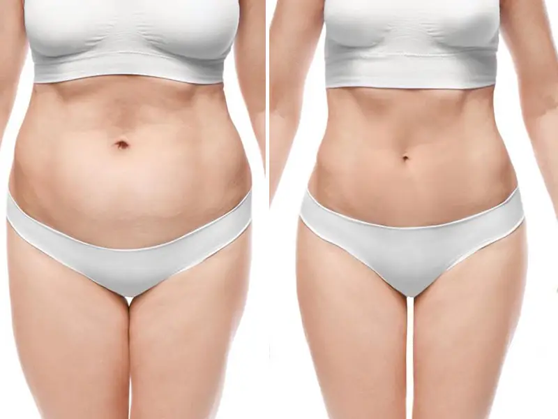 Tummy Tuck (Abdominoplasty) Tummy Tuck (Abdominoplasty)