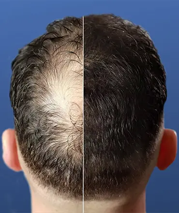 Hair Transplant - Medical Tourism Turkey