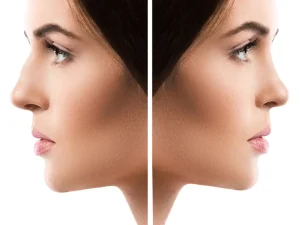 Rhinoplasty - Before & After - Medical Tourism Turkey
