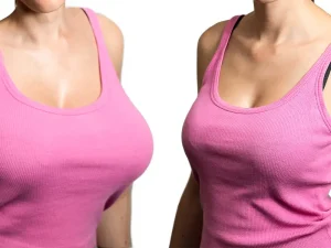 Before & After - Medical Tourism Turkey