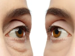 Before & After - Medical Tourism Turkey