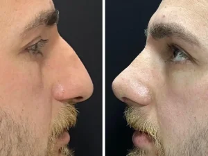 Rhinoplasty - Before & After