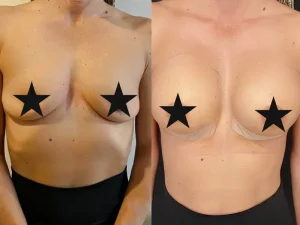 Breast Implant - Before & After - Medical Tourism Turkey