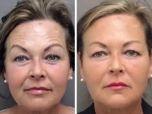 Eyelid Surgery - Medical Tourism Turkey