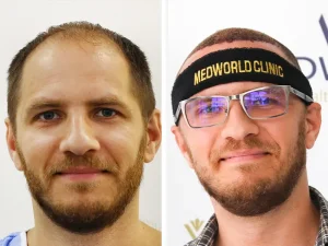 Hair Transplant - Before & After - Medical Tourism Turkey