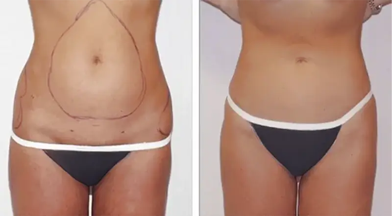 Fettabsaugung (Liposuktion) Fettabsaugung (Liposuktion)