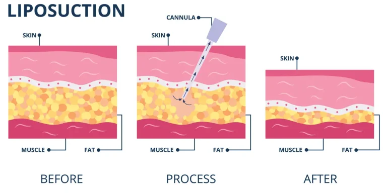 Fettabsaugung (Liposuktion)