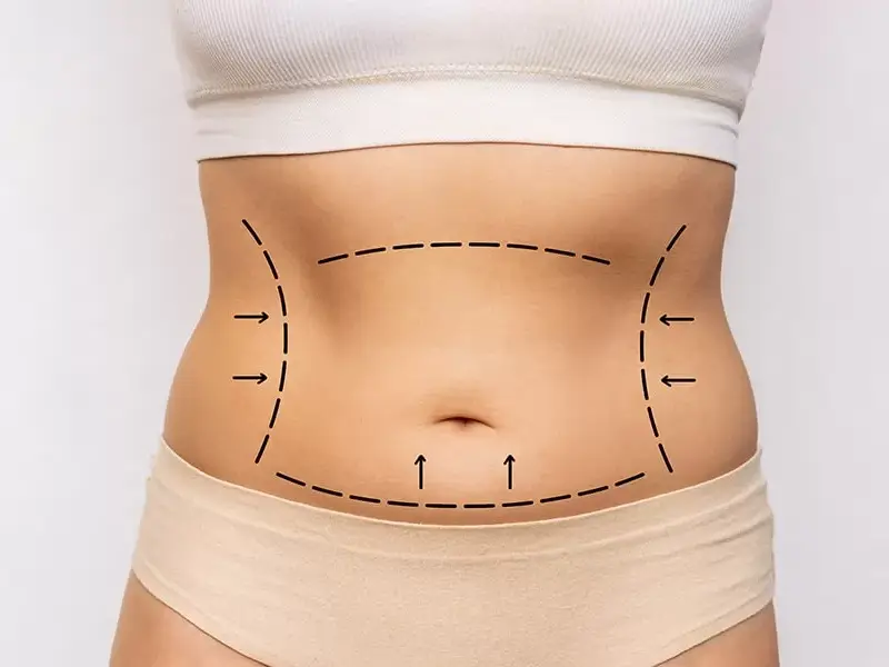 Fettabsaugung (Liposuktion)