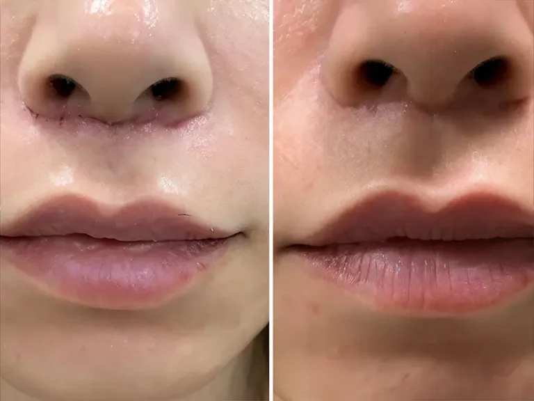 Lip Lift