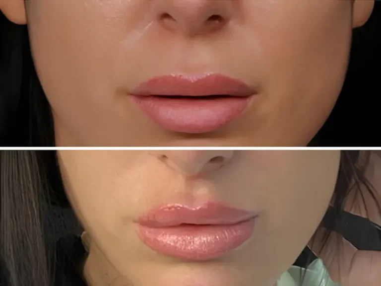 Lip Lift