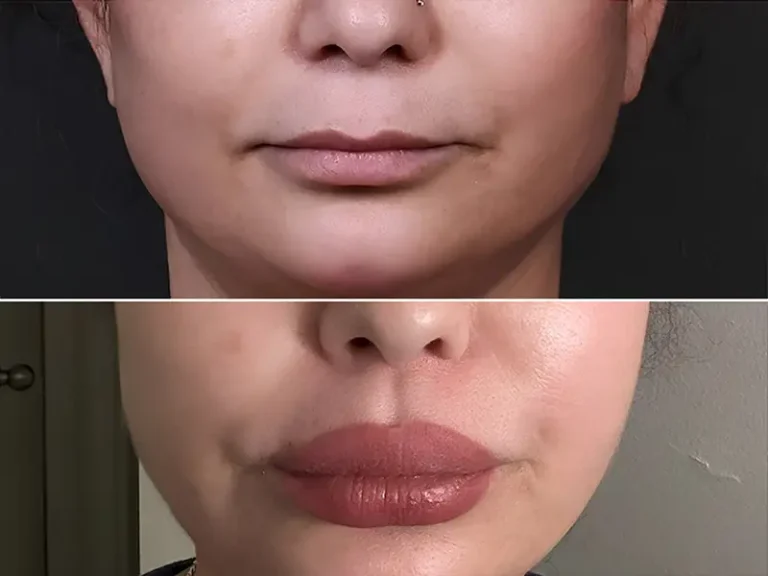 Lip Lift