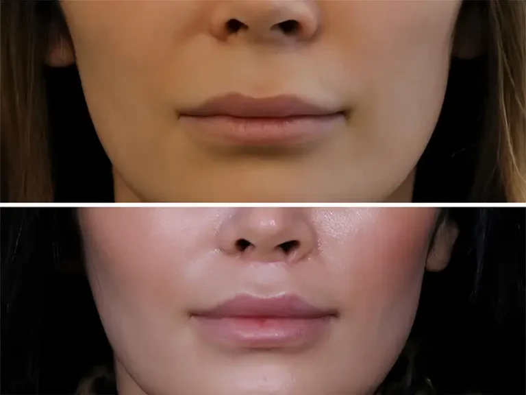 Lip Lift