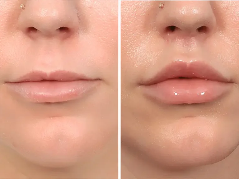 Lip Lift
