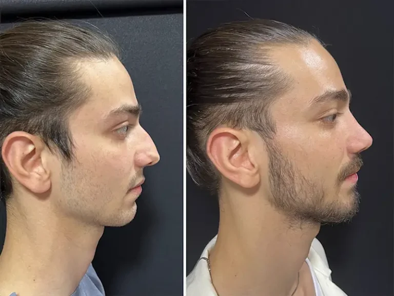 Rhinoplastik