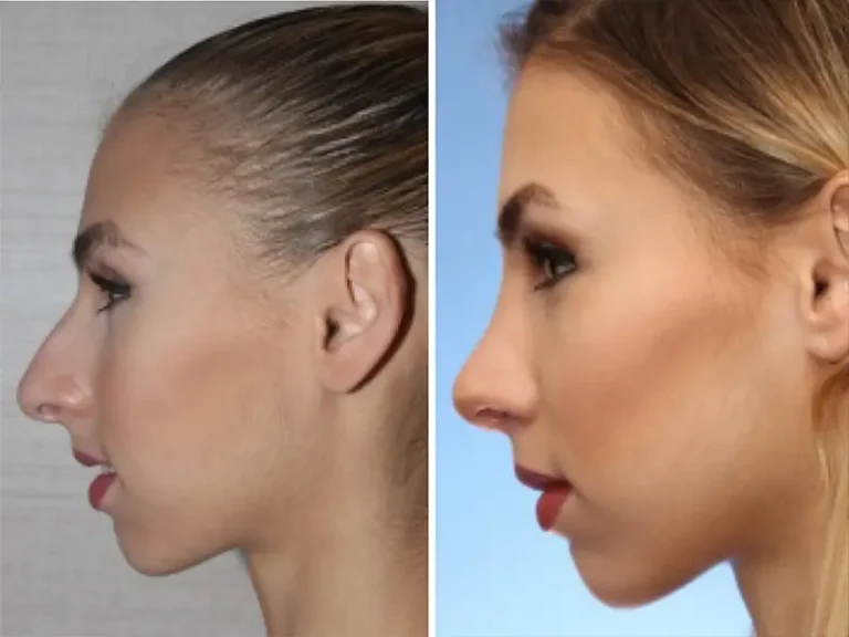 Rhinoplastik
