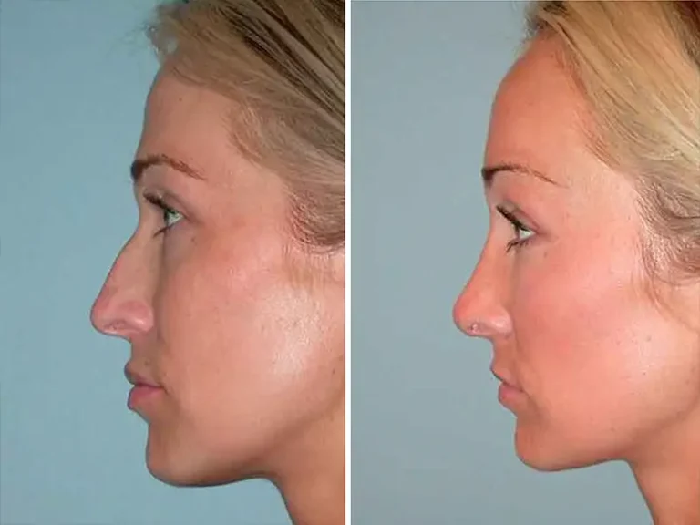 Rhinoplastik