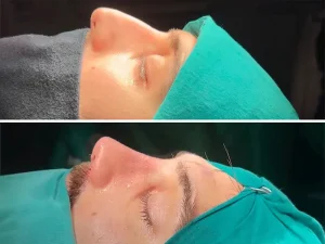 Rhinoplasty