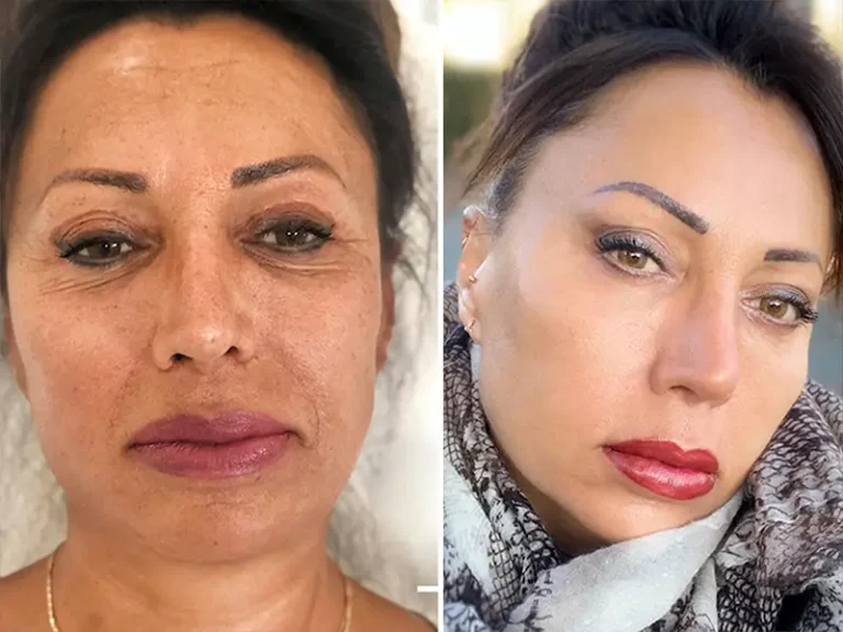 Face & Neck Lift