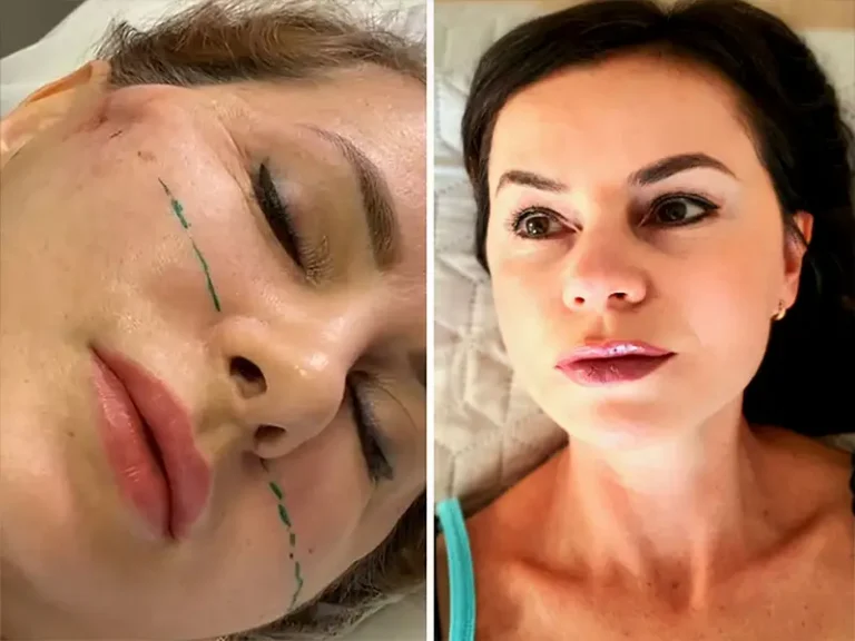 Face & Neck Lift