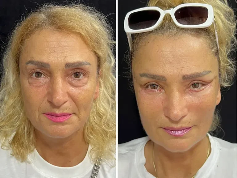 Face & Neck Lift