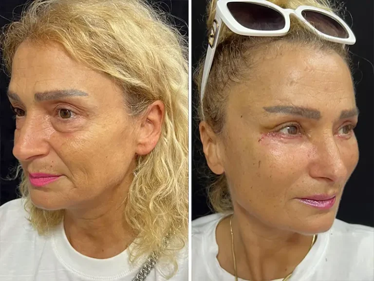 Face & Neck Lift
