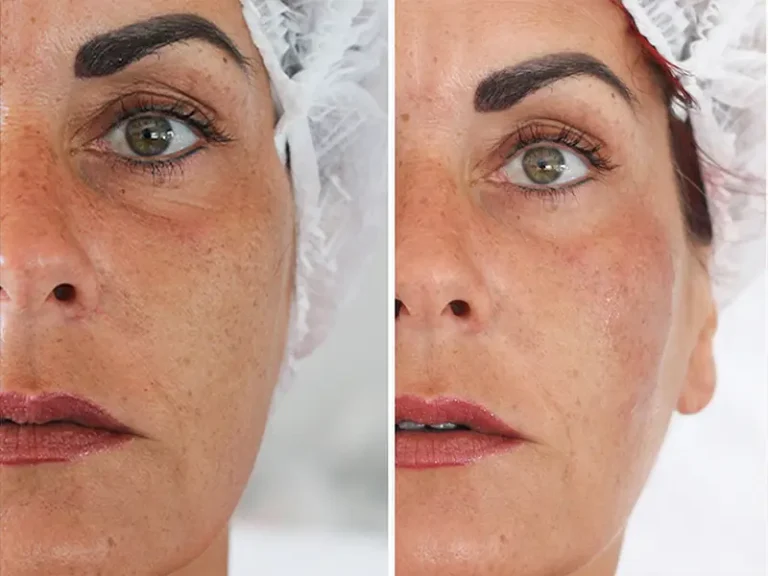 Face & Neck Lift