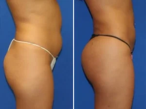 Liposuction