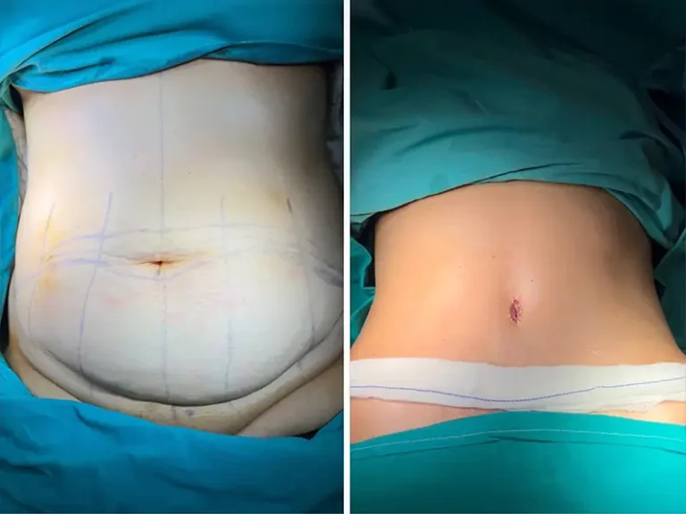Абдоминопластика (Tummy Tuck)