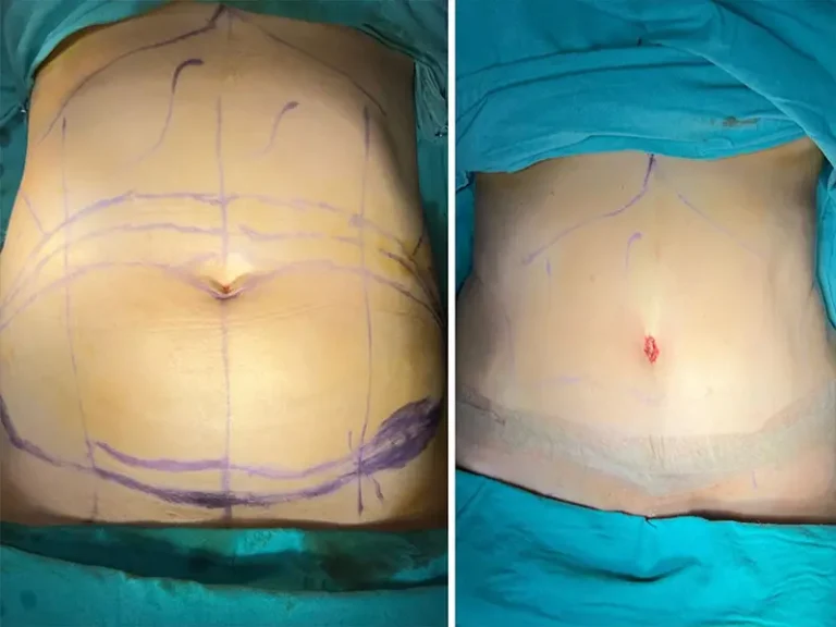 Абдоминопластика (Tummy Tuck)