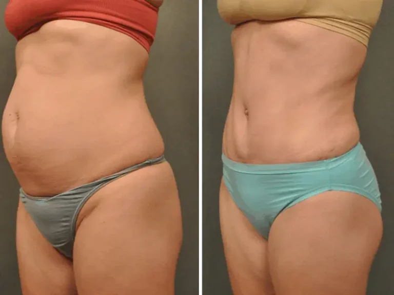 Абдоминопластика (Tummy Tuck)