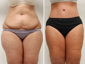 Tummy Tuck (Abdominoplasty)