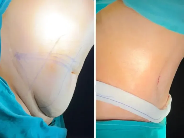 Абдоминопластика (Tummy Tuck)