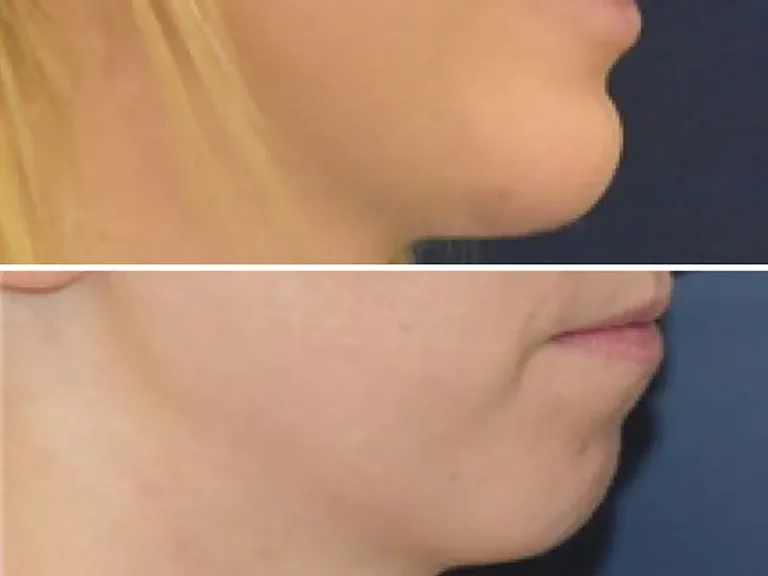 Genioplasty (Chin Surgery)