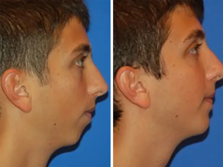 Genioplasty (Chin Surgery)