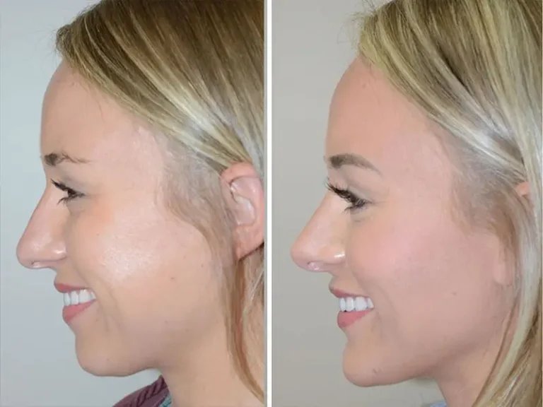 Genioplasty (Chin Surgery)