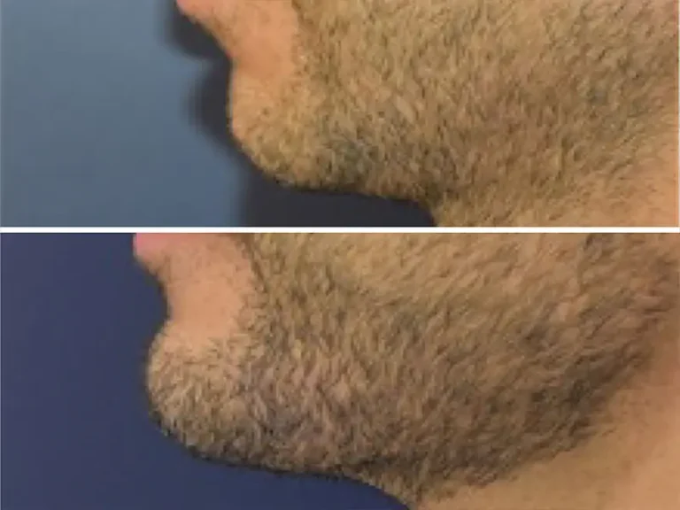 Genioplasty (Chin Surgery)