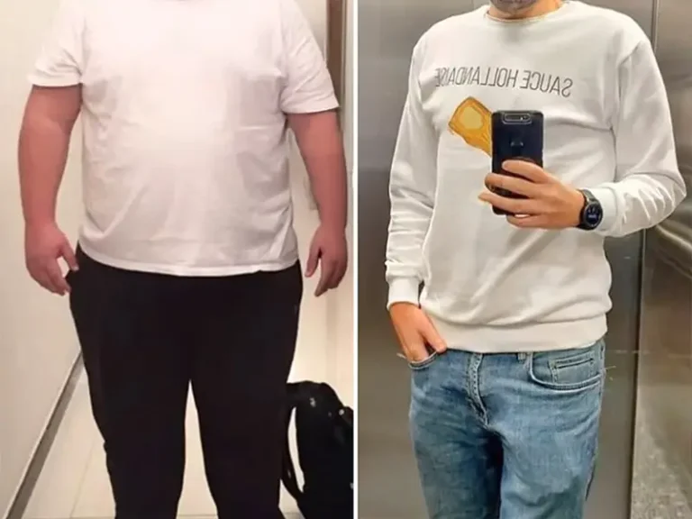 Gastric Sleeve Surgery