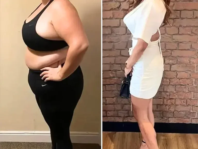 Gastric Sleeve Surgery