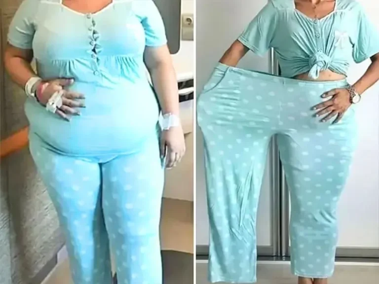 Gastric Sleeve Surgery