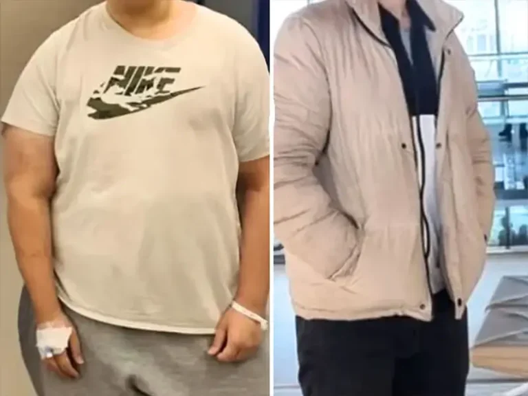 Gastric Sleeve Surgery