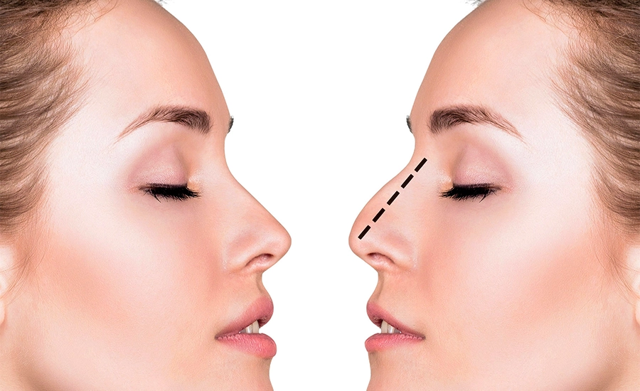 Cosmetic Rhinoplasty, Rhinoplasty in antalya