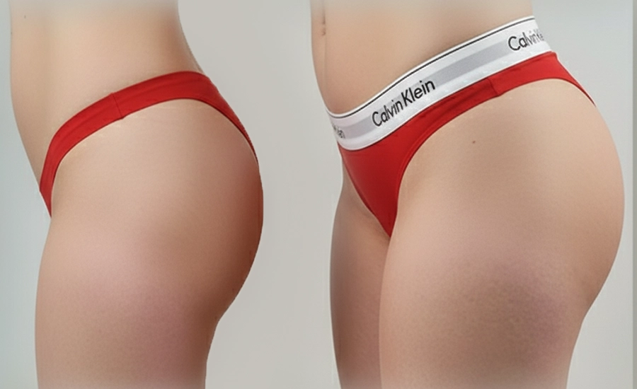 Brazilian Butt Lift, What Is a Brazilian Butt Lift, BBL