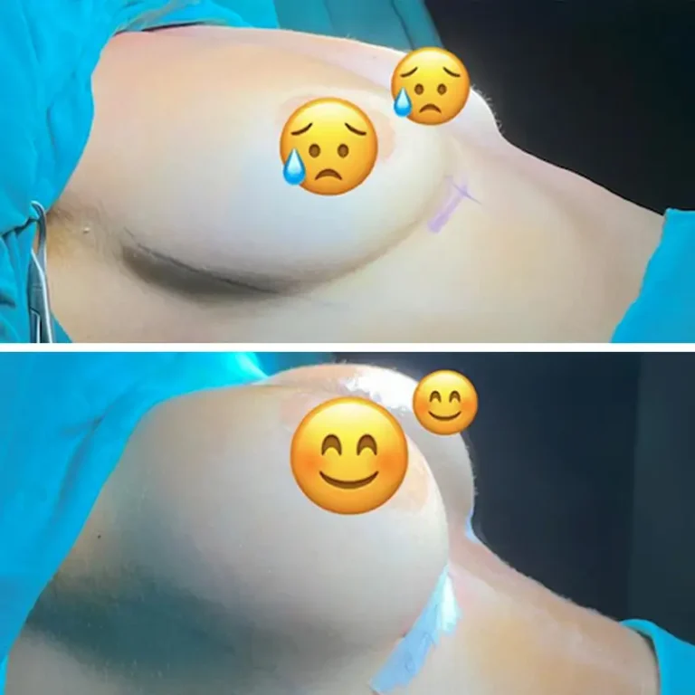 Breast Augmentation (Breast Implants)