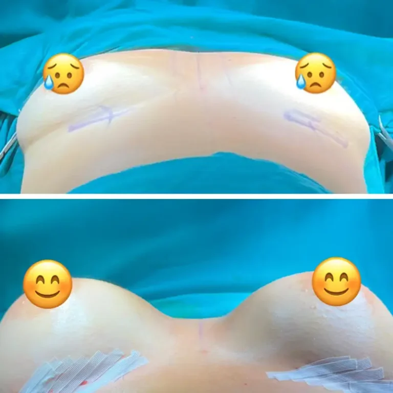 Breast Augmentation (Breast Implants)