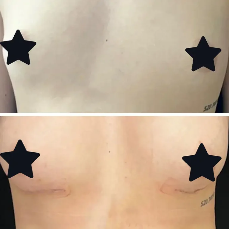 Breast Augmentation (Breast Implants)