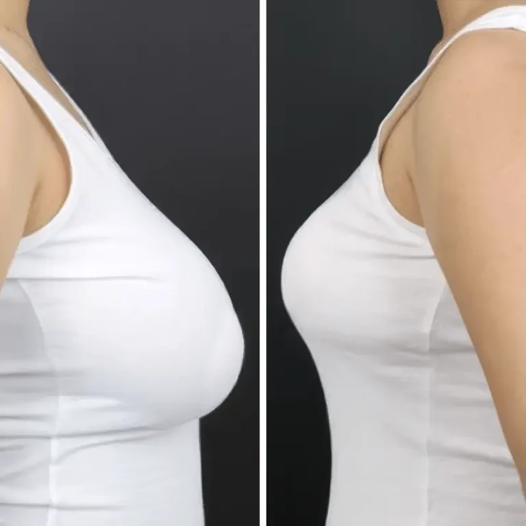 Breast Reduction - Before & After