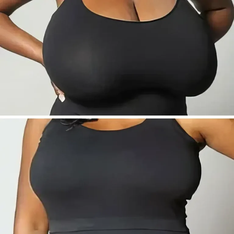 Breast Reduction - Before & After